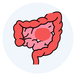Medical illustration of the human colon with a highlighted abnormal growth representing colorectal disease, intestinal tumor, or colon cancer.